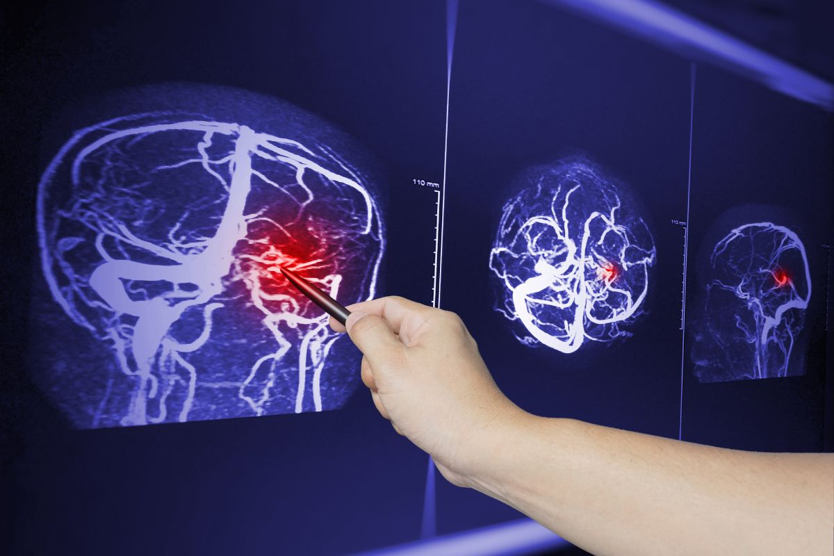 King and Beaty - common injuries in rear-end collisions 